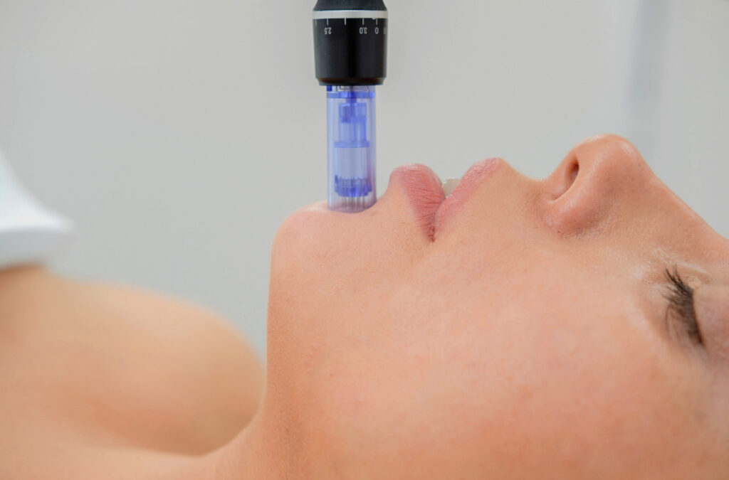 Aquafacial in Leonberg Microneedling in Leonberg